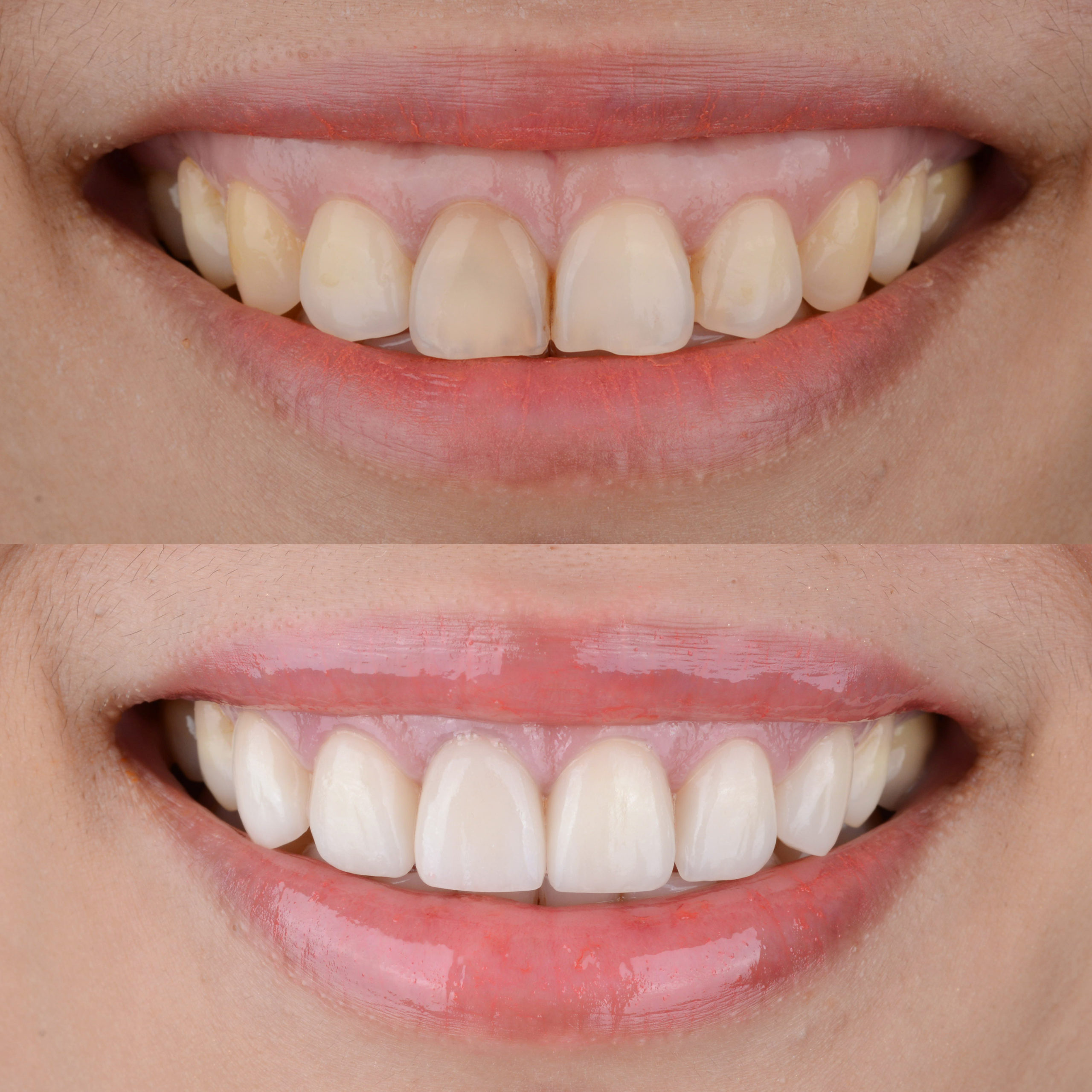 Des facettes dentaires pour un meilleur sourire